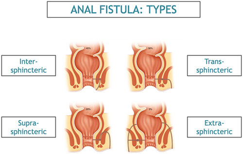 Anal Fistula