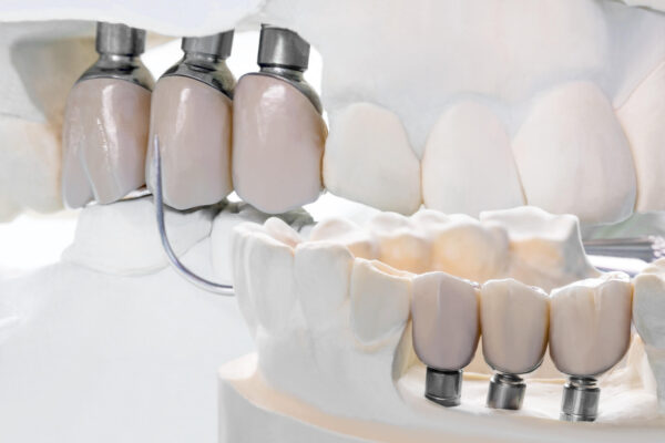 Dental Bridges in Anchorage