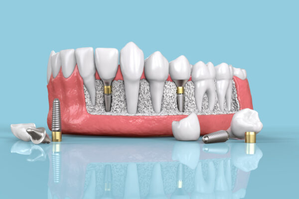 Explore the Best Place to Get Affordable Dental Implants