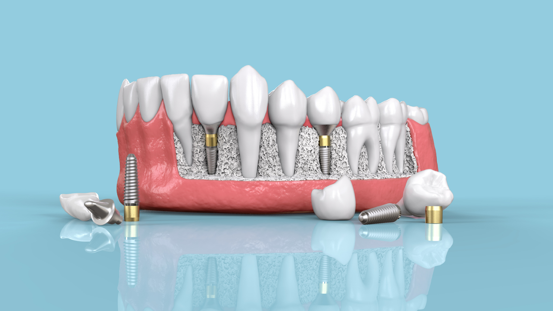 Explore the Best Place to Get Affordable Dental Implants