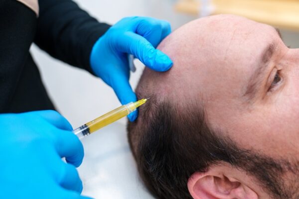 Hair PRP Treatment in Mumbai - Midas Wellness Hub