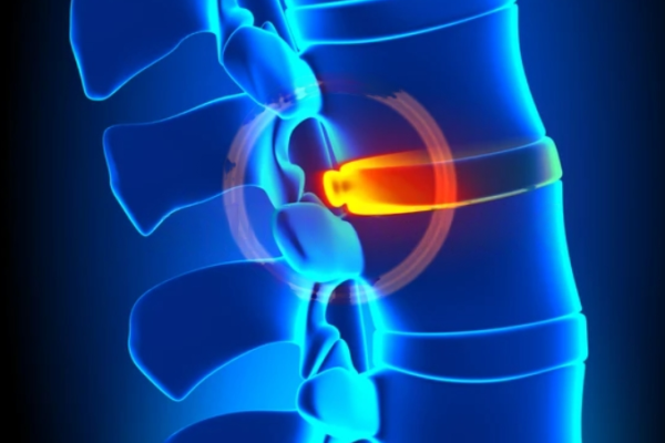 Disc Bulge Treatment