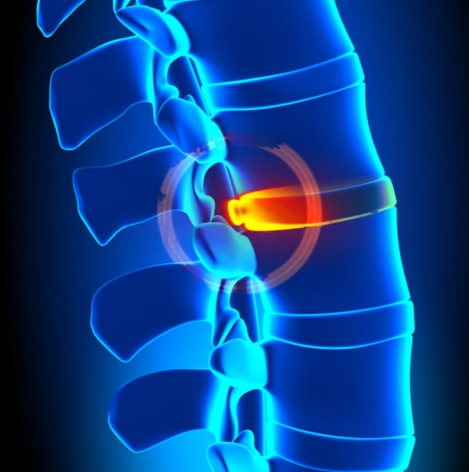 Disc Bulge Treatment