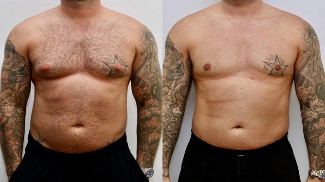 gynecomastia surgery uae