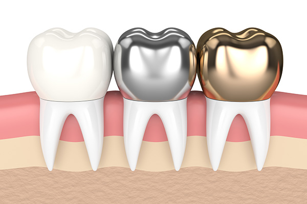 Dental Crowns 