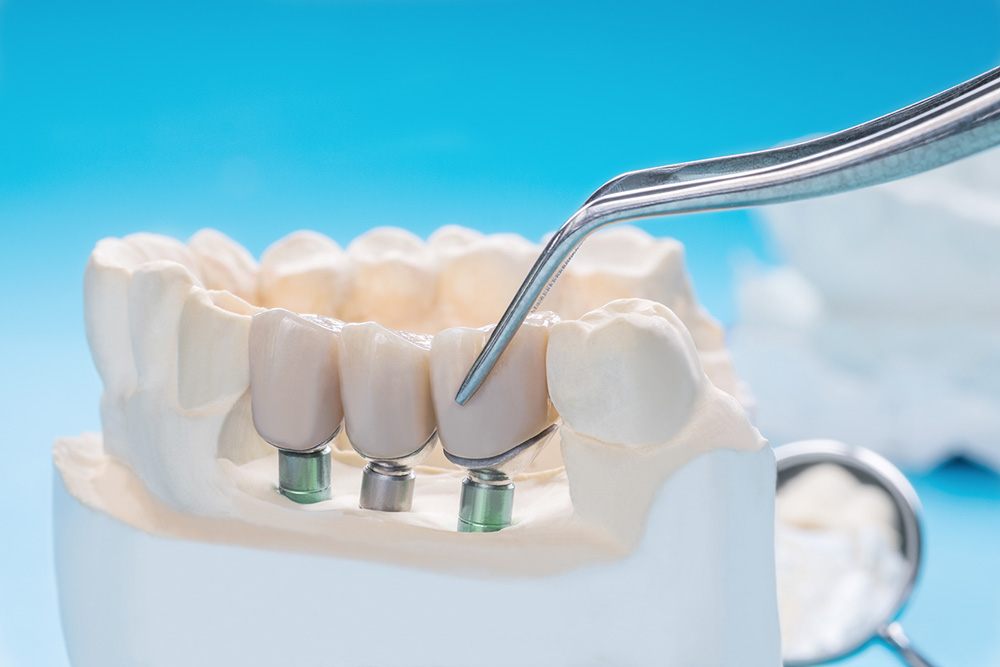 Dental implants 