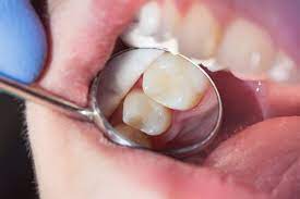 Dental Crowns