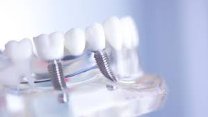 Dental implants