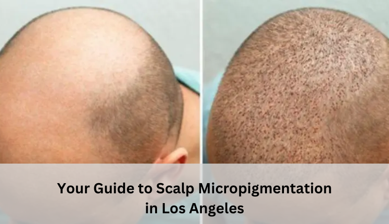 scalp micropigmentation los angeles