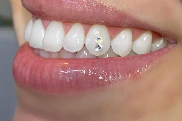 Transform Your Smile: Diamond Teeth in Dubai