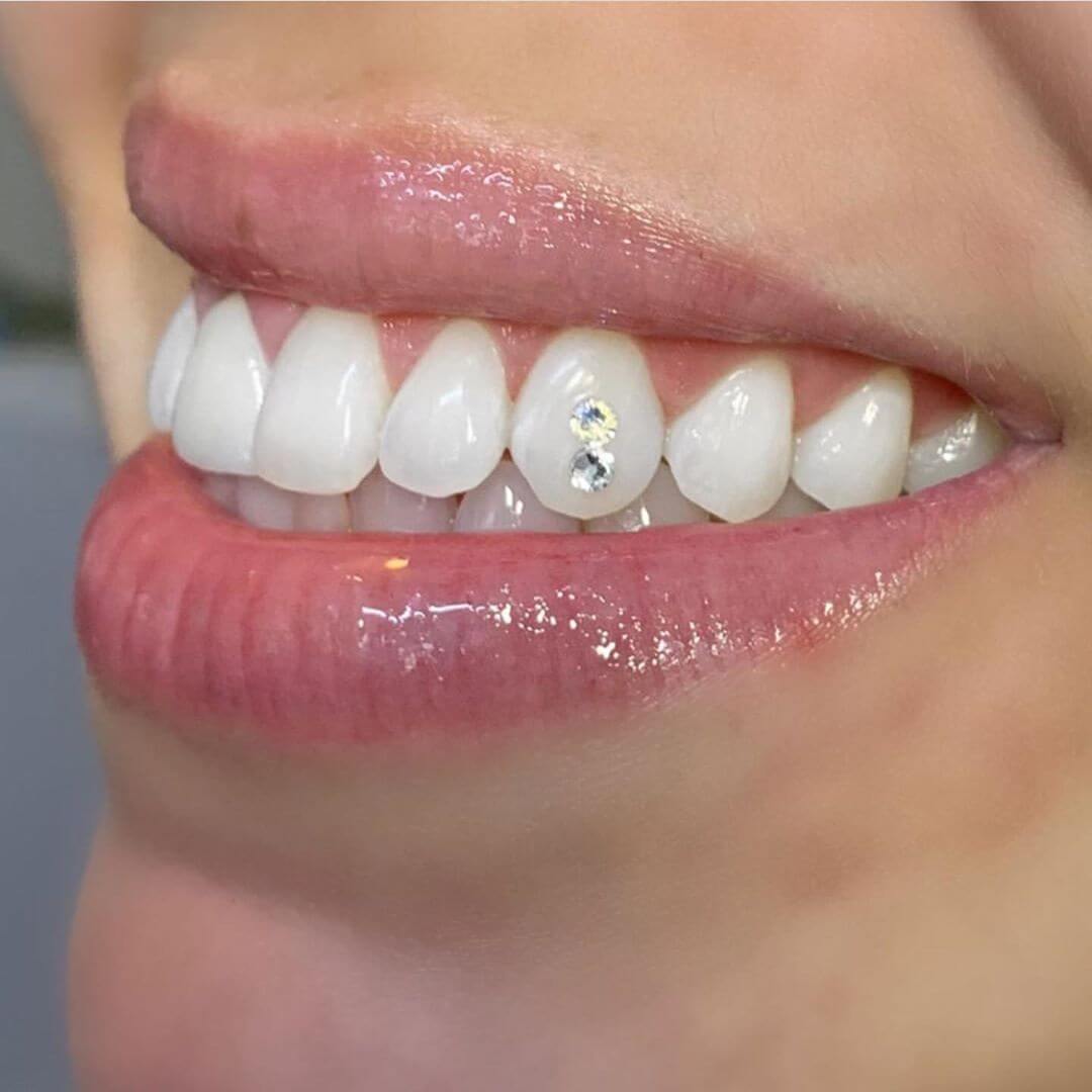 Transform Your Smile: Diamond Teeth in Dubai